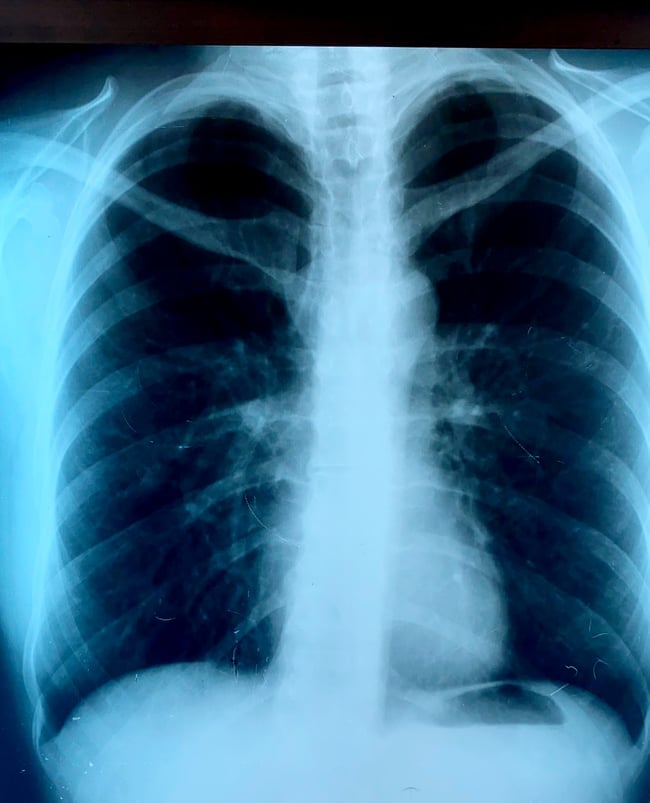 Snimak pluća FOTO: Privatna arhiva